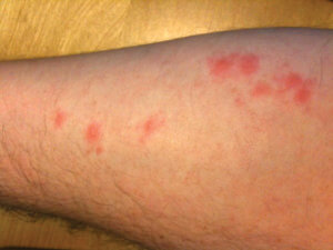 Bedbug bite on arm